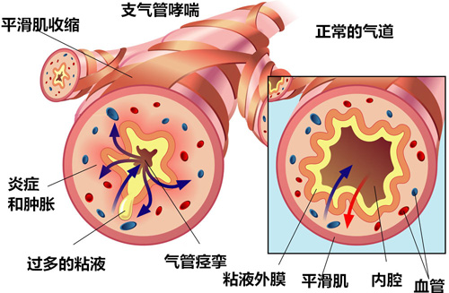 《职场健康课》：让职场人从此远离哮喘